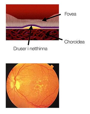 Netthinnesykdommer: Tørr AMD