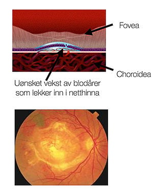 Netthinnesykdommer: Våt AMD