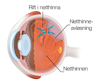 Netthinneavløsning: Rhegmatogen