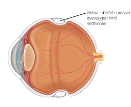 Netthinneavløsning: Skleral 